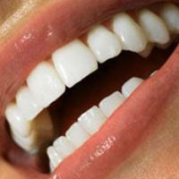 سفید کردن طبیعی دندان ها در خانه